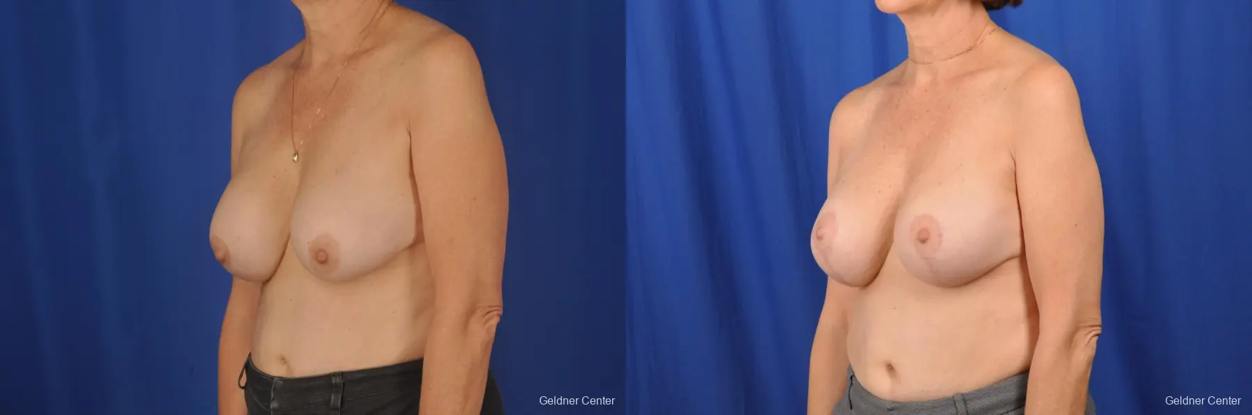 Breast Lift Hinsdale, Chicago 2058 - Before and After 4