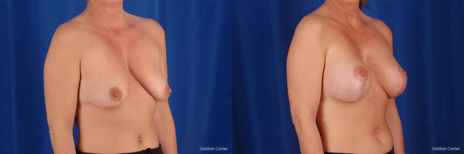 Breast Lift Lake Shore Dr, Chicago 2308 - Before and After 3