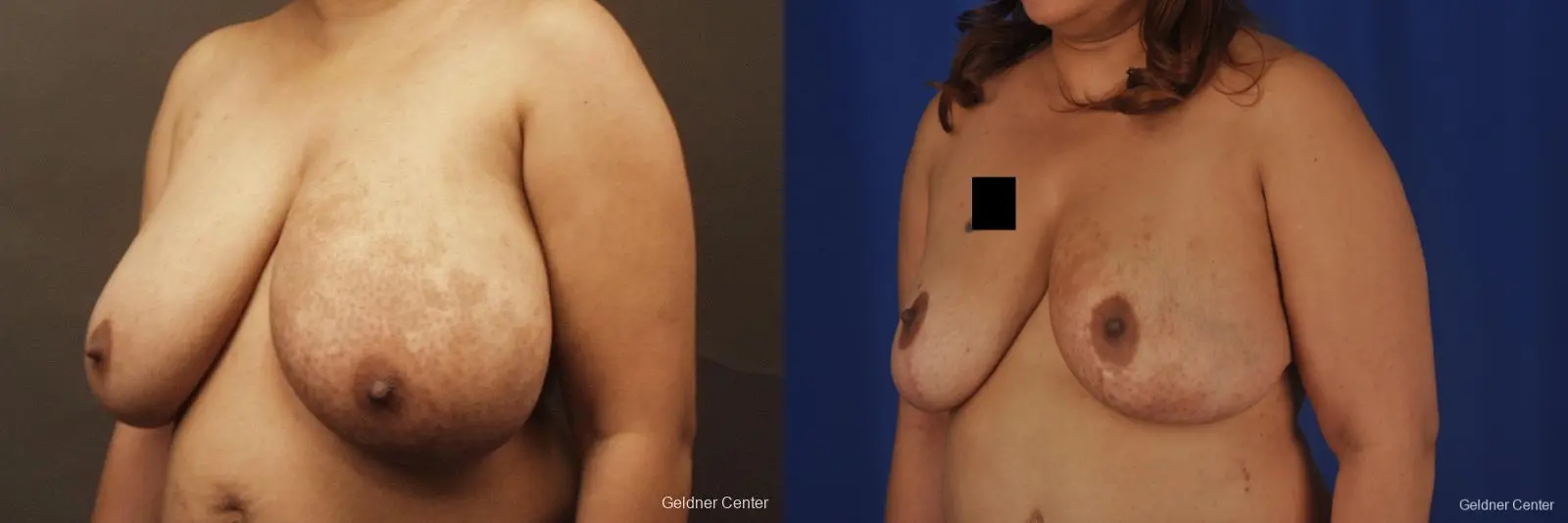 Chicago Breast Reduction 2375 - Before and After 4