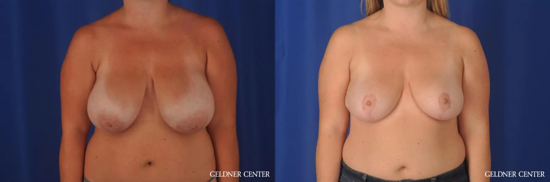 Chicago Breast Reduction 11855 - Before and After