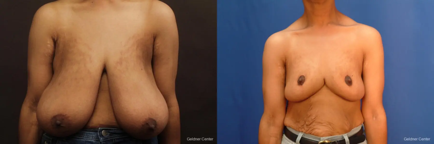 Breast Reduction Hinsdale 2440 - Before and After