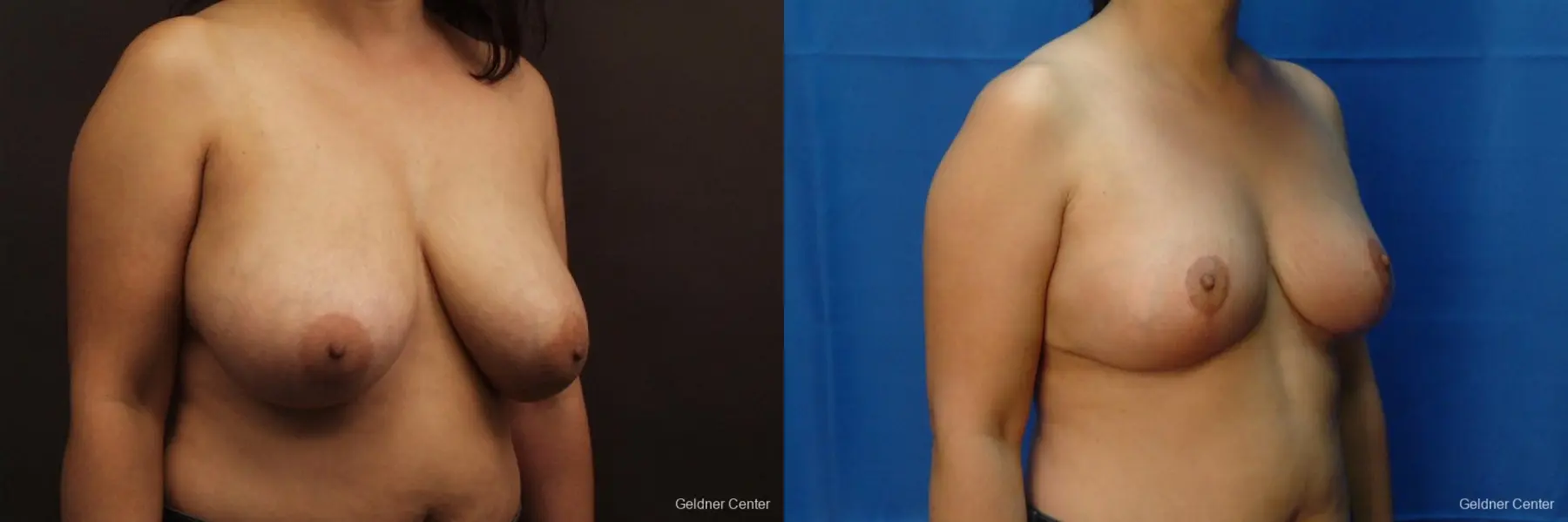 Chicago Breast Reduction 2416 - Before and After 3