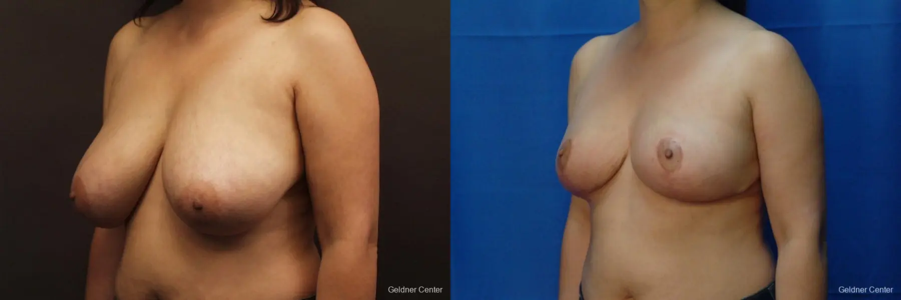 Chicago Breast Reduction 2416 - Before and After 4