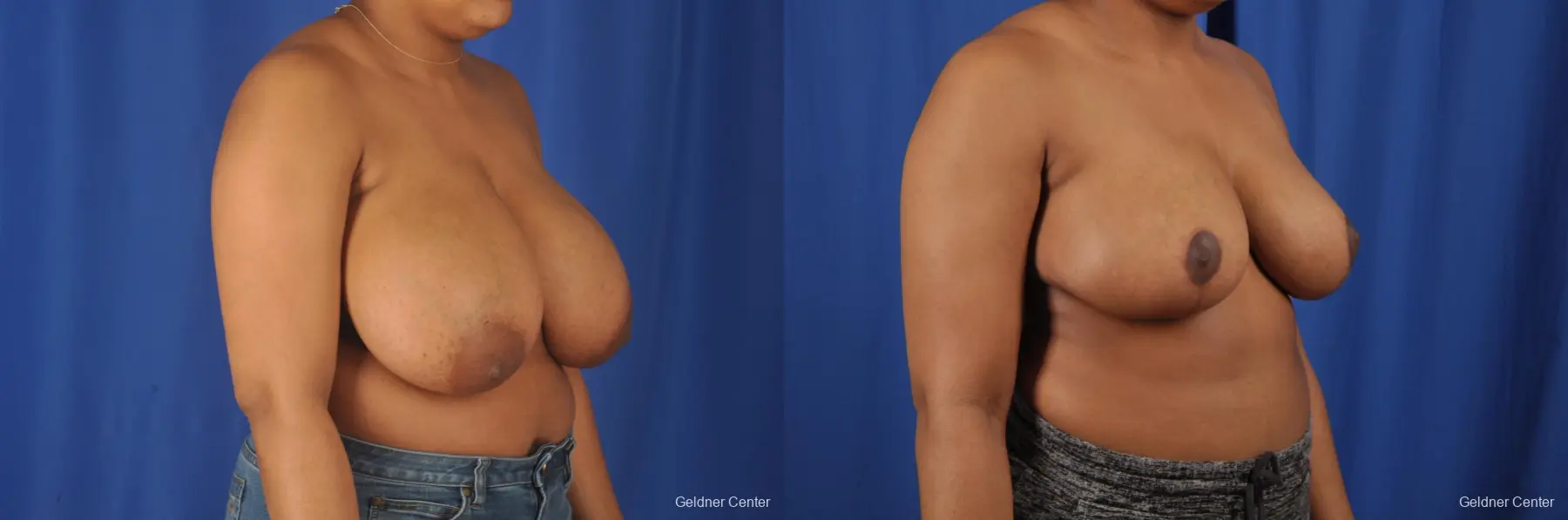 Breast Reduction: Patient 30 - Before and After 3