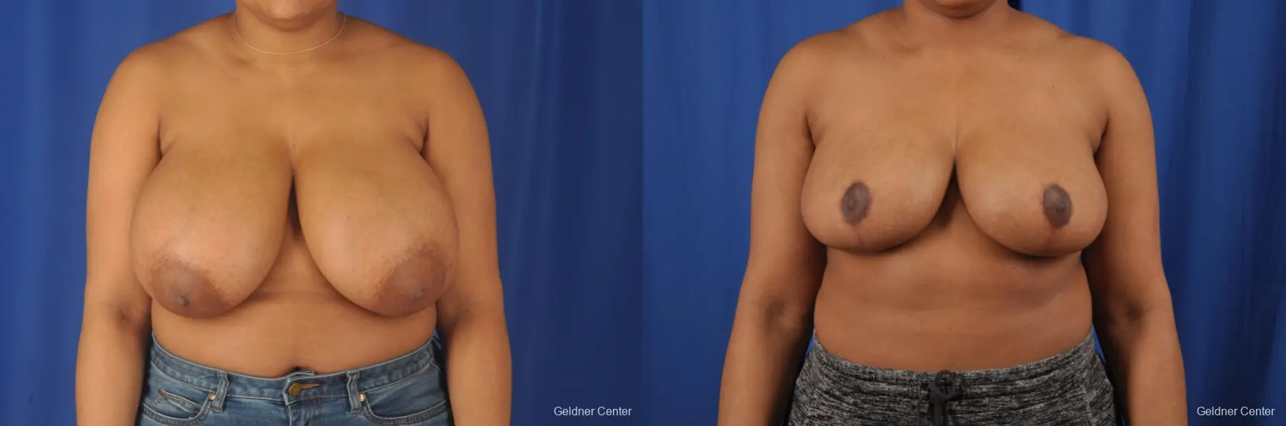 Breast Reduction: Patient 30 - Before and After 1