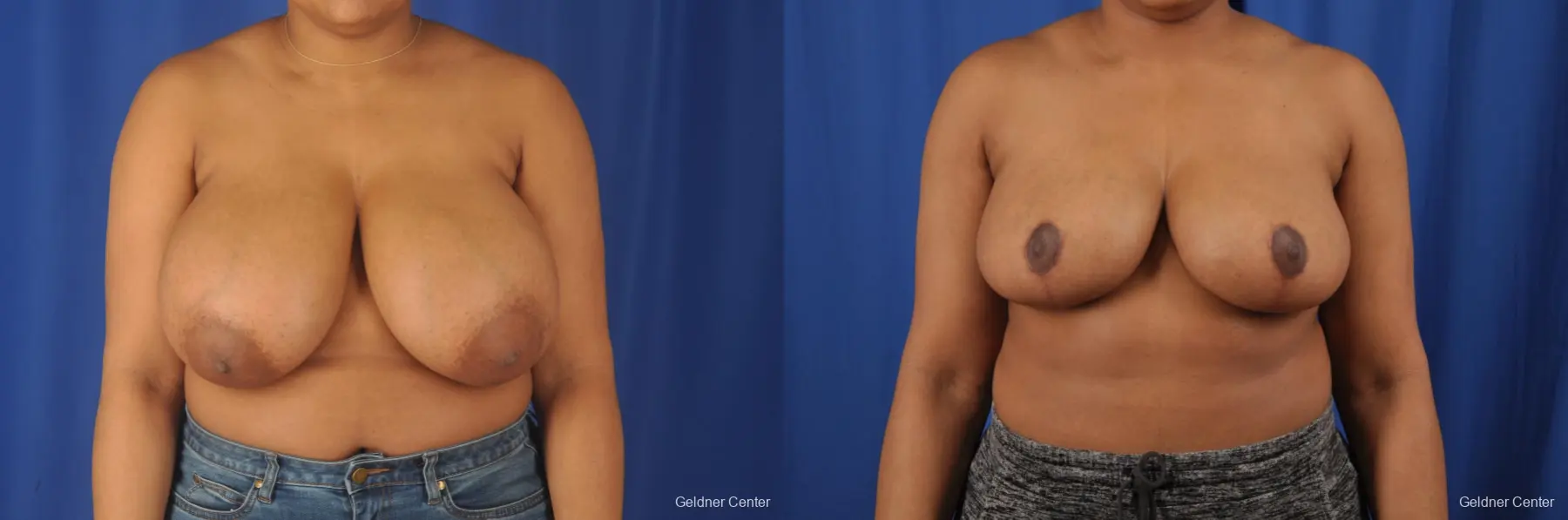 Breast Reduction: Patient 30 - Before and After  