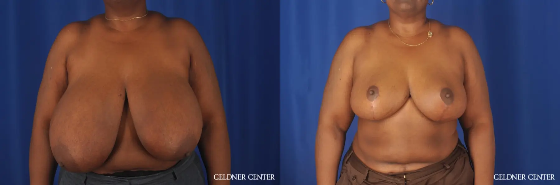 Chicago Breast Reduction 11871 - Before and After