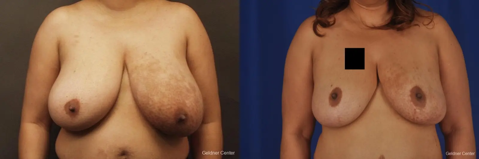 Chicago Breast Reduction 2375 - Before and After 1