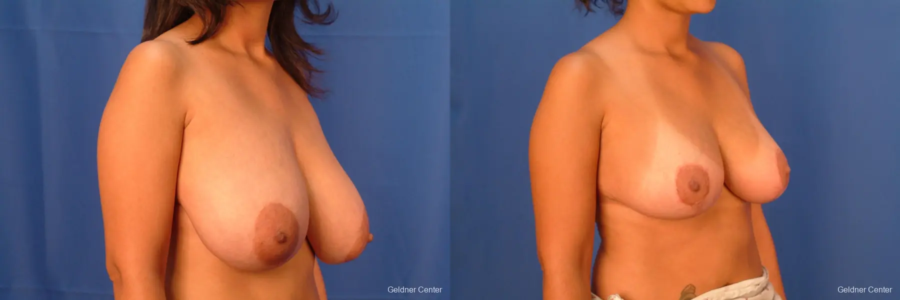 Breast Reduction Lake Shore Dr, Chicago 2417 - Before and After 2