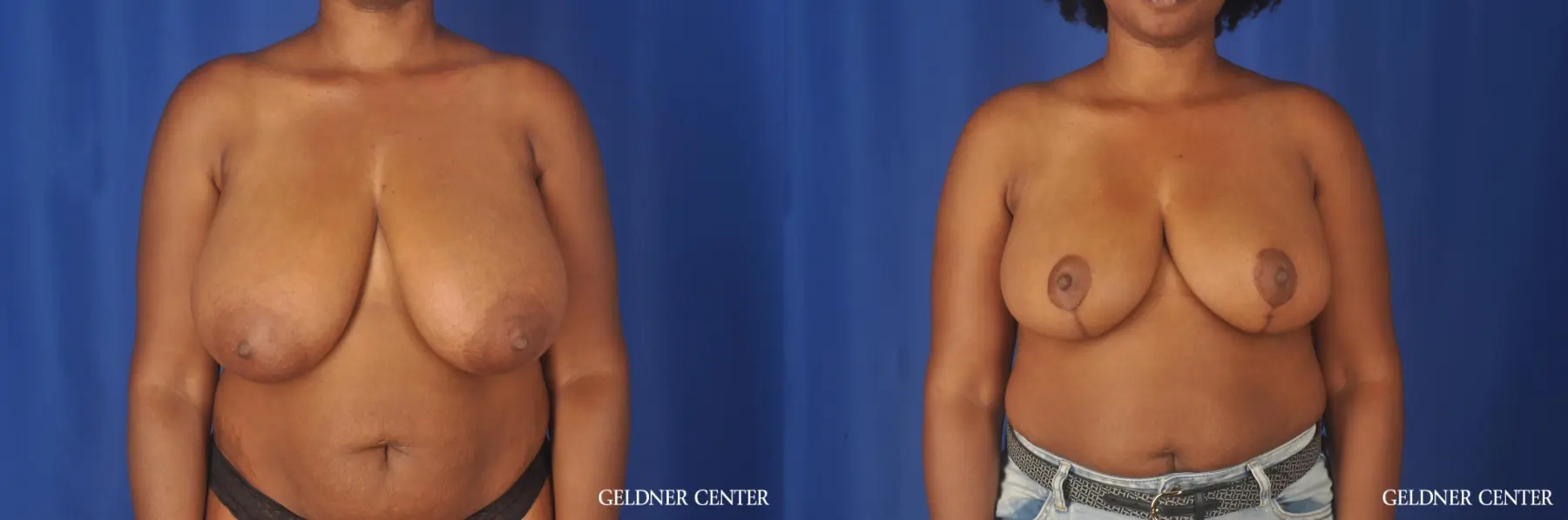 Breast Reduction Lake Shore Dr, Chicago 12824 - Before and After