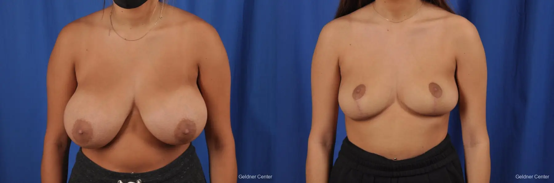 Breast Reduction: Patient 38 - Before and After  
