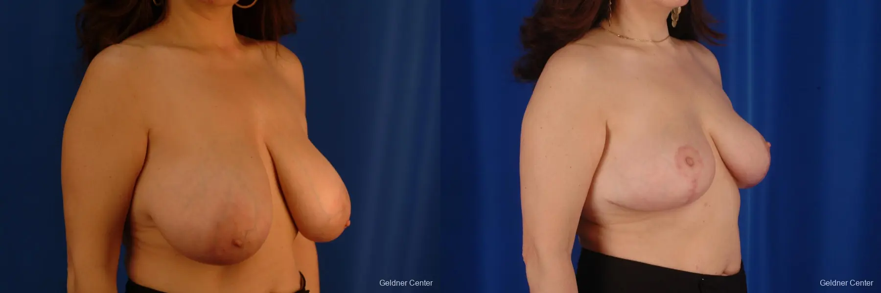 Breast Reduction Streeterville, Chicago 2289 - Before and After 3