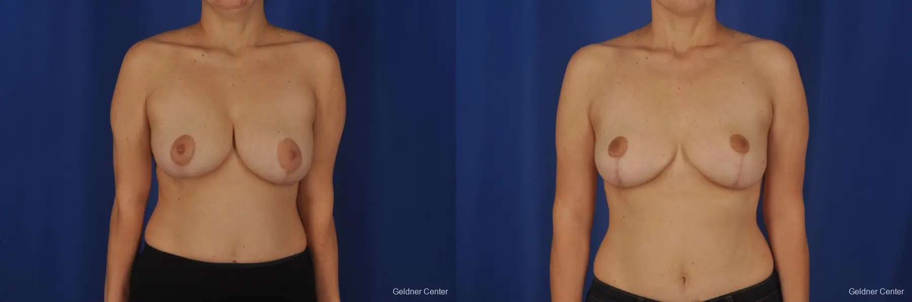 Chicago Breast Reduction 2068 - Before and After 1
