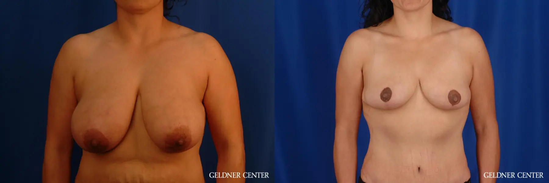 Breast Reduction Hinsdale, Chicago 2630 - Before and After