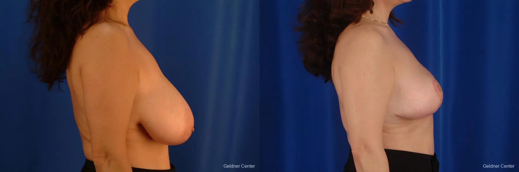 Breast Reduction Streeterville, Chicago 2289 - Before and After 2