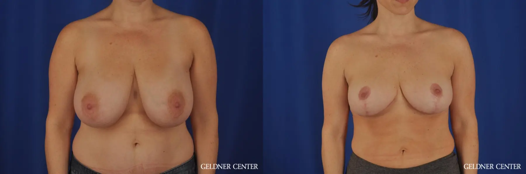 Breast Reduction Hinsdale, 4287 - Before and After