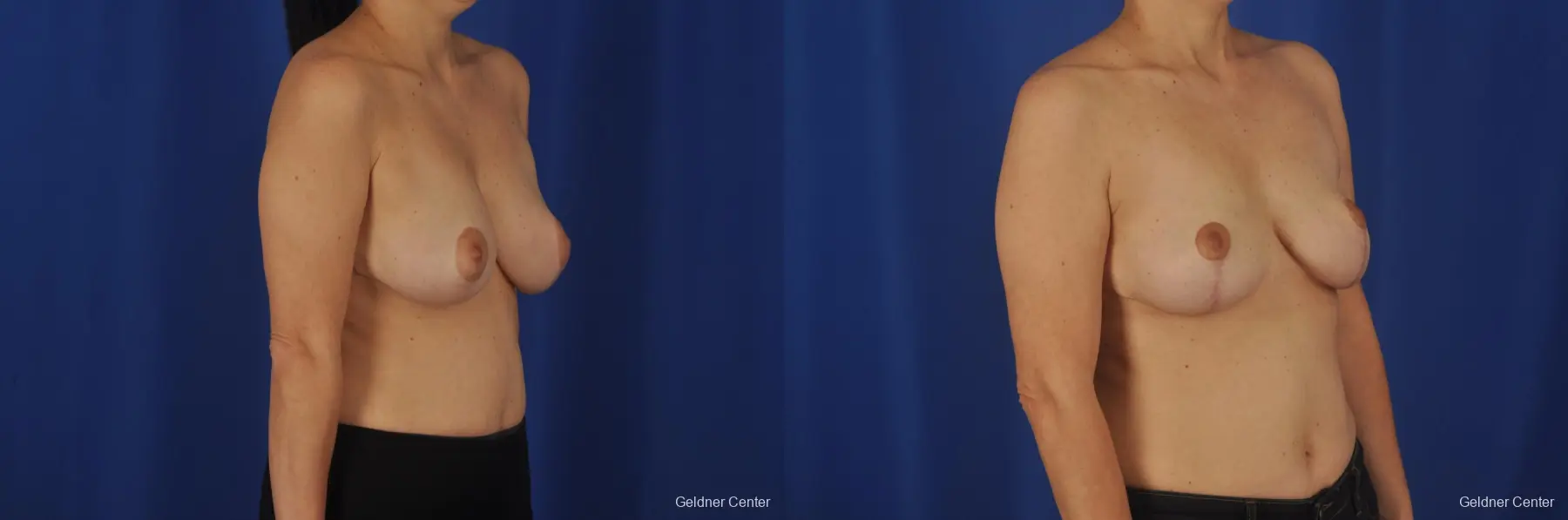 Chicago Breast Reduction 2068 - Before and After 2