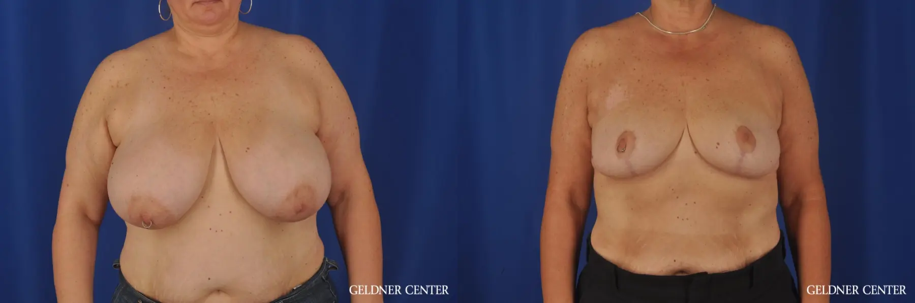 Breast Reduction Lake Shore Dr, Chicago 3223 - Before and After