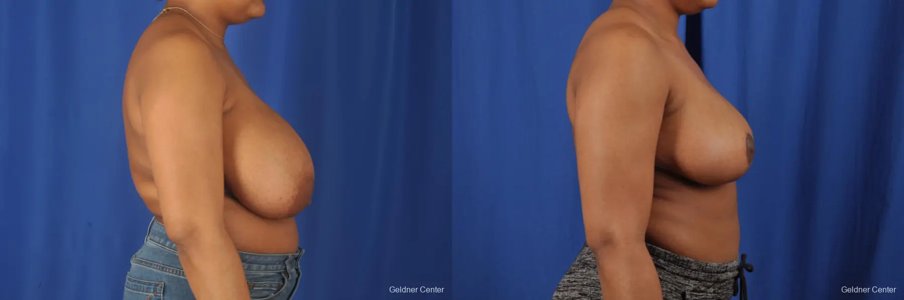 Breast Reduction: Patient 30 - Before and After 2