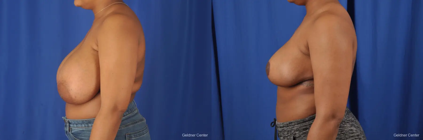 Breast Reduction: Patient 30 - Before and After 4