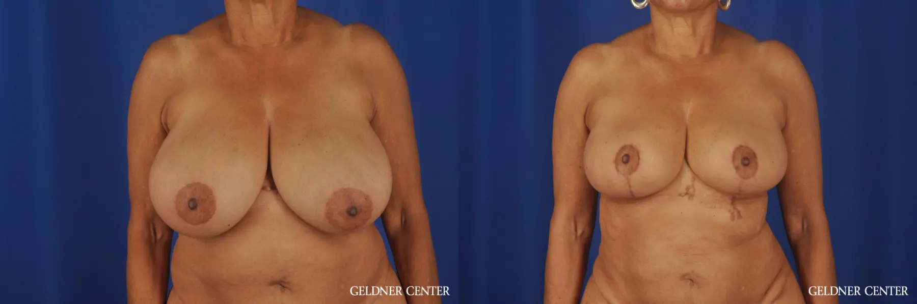 Breast Reduction Streeterville, Chicago 6650 - Before and After