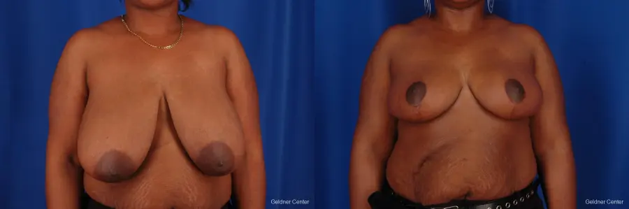 Breast Reduction Hinsdale, Chicago 2334 - Before and After 1