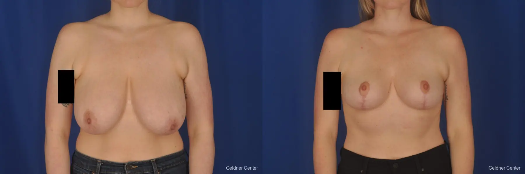 Breast Reduction: Patient 40 - Before and After  