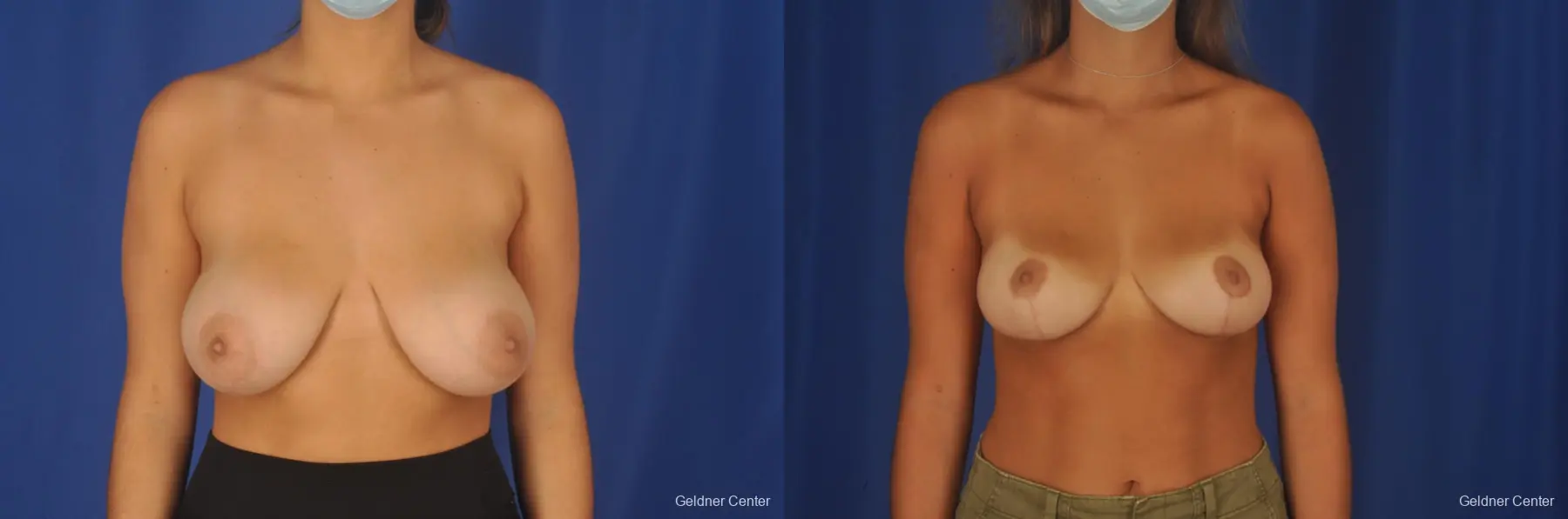 Breast Reduction: Patient 36 - Before and After  