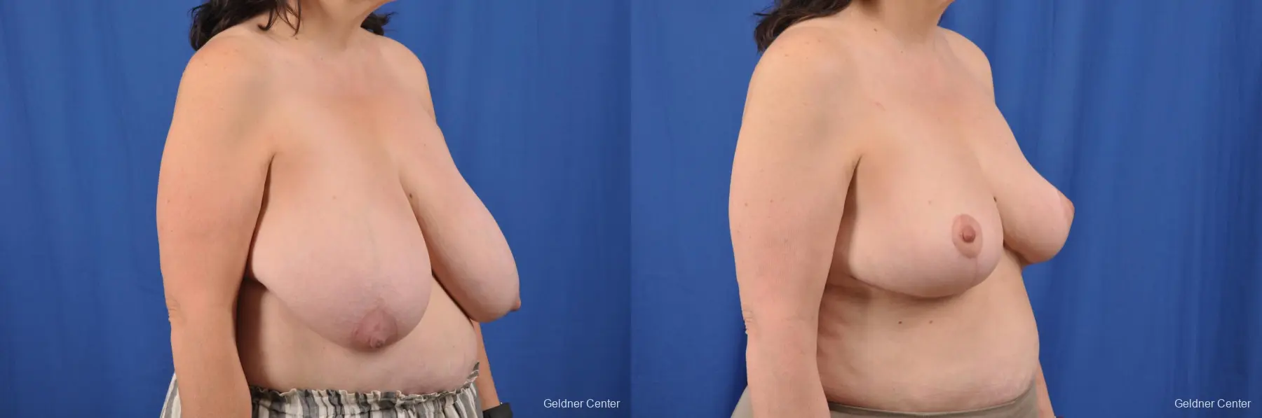 Breast Reduction: Patient 29 - Before and After 2
