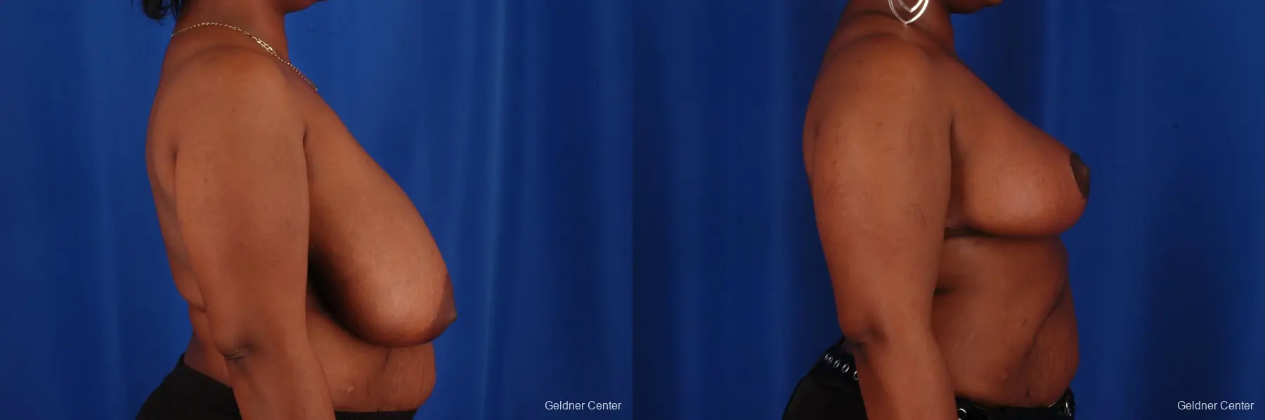 Breast Reduction Hinsdale, Chicago 2334 - Before and After 2