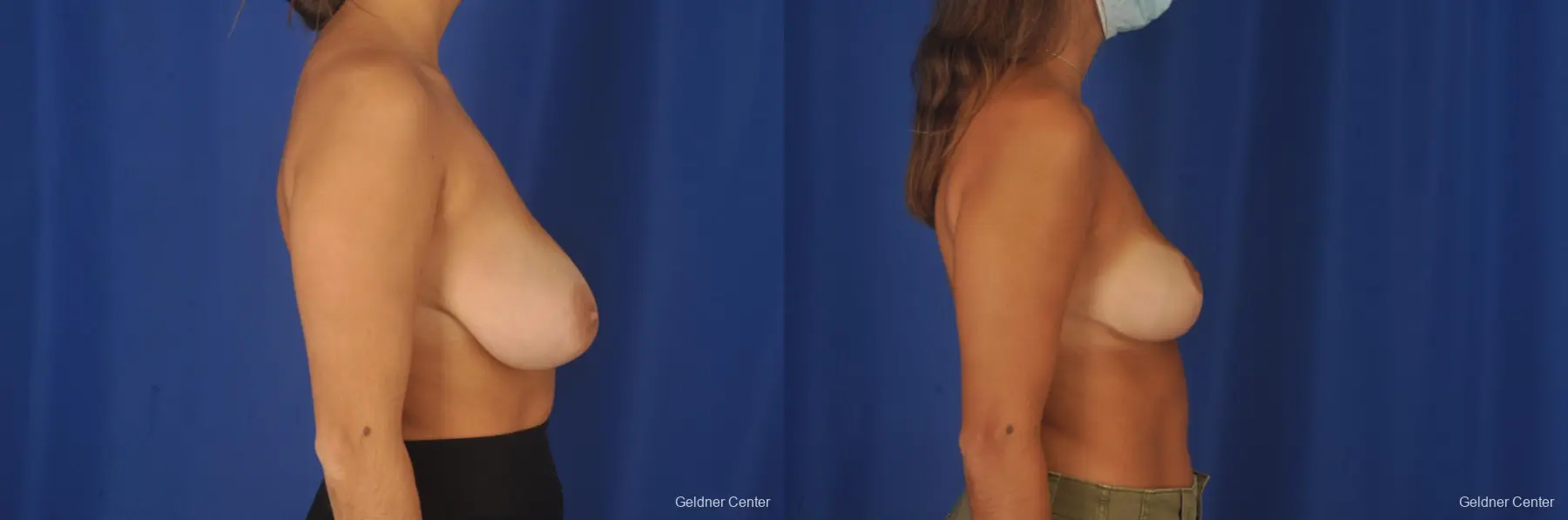 Breast Reduction: Patient 36 - Before and After 2