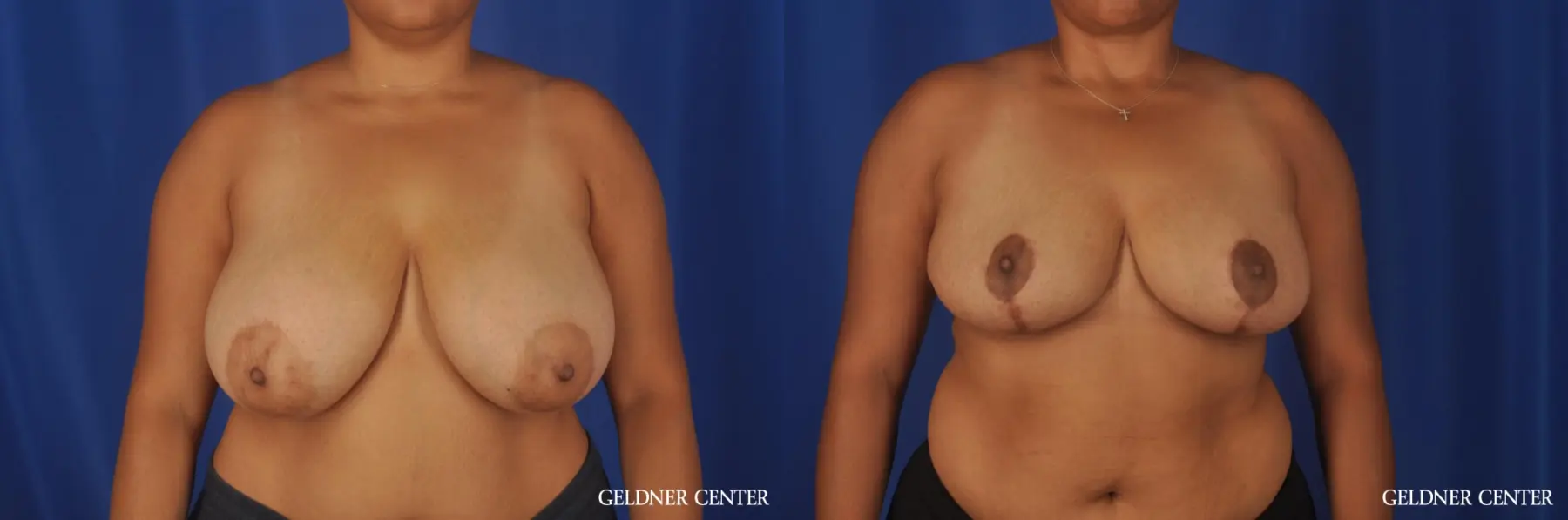 Breast Reduction Lake Shore Dr, Chicago 8761 - Before and After