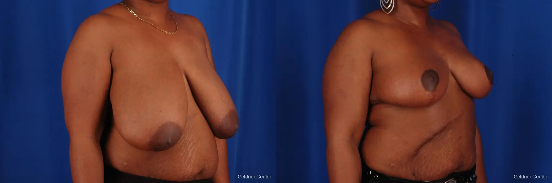 Breast Reduction Hinsdale, Chicago 2334 - Before and After 3