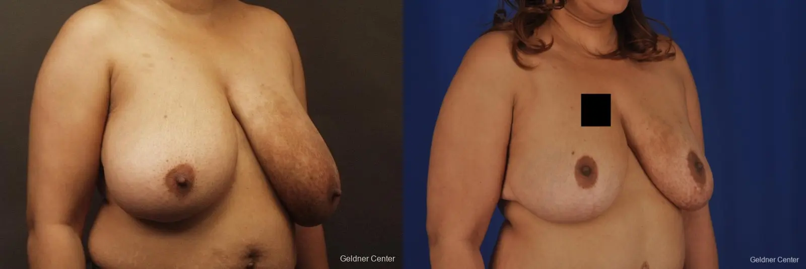 Chicago Breast Reduction 2375 - Before and After 3
