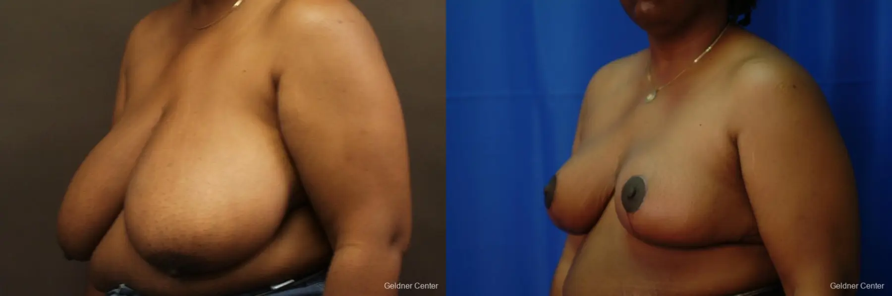 Chicago Breast Reduction 2406 - Before and After 4