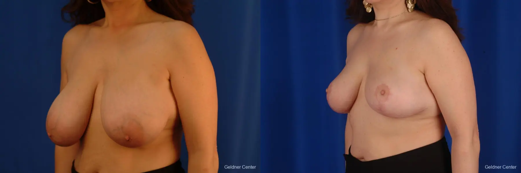 Breast Reduction Streeterville, Chicago 2289 - Before and After 4