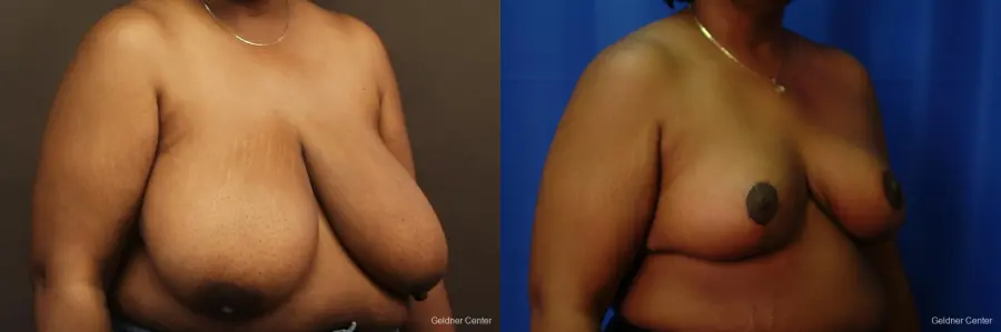 Chicago Breast Reduction 2406 - Before and After 3