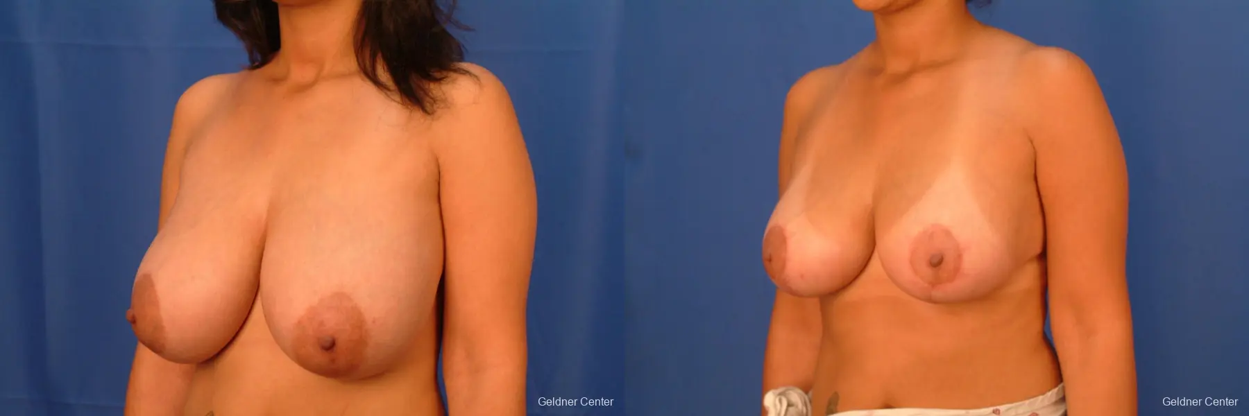 Breast Reduction Lake Shore Dr, Chicago 2417 - Before and After 3