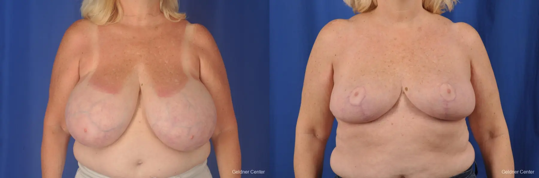 Breast Reduction: Patient 28 - Before and After 1