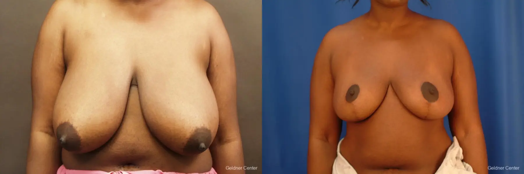 Chicago Breast Reduction 2441 - Before and After 1