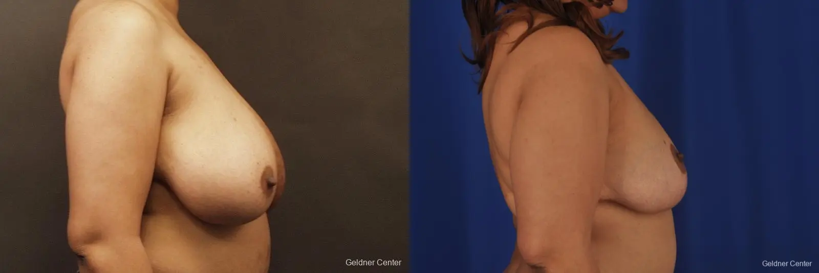 Chicago Breast Reduction 2375 - Before and After 2