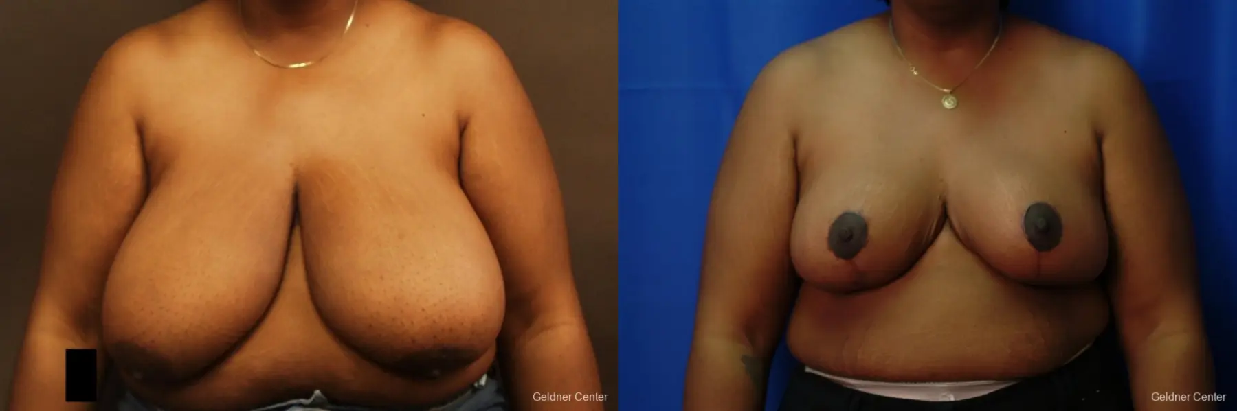 Chicago Breast Reduction 2406 - Before and After 1