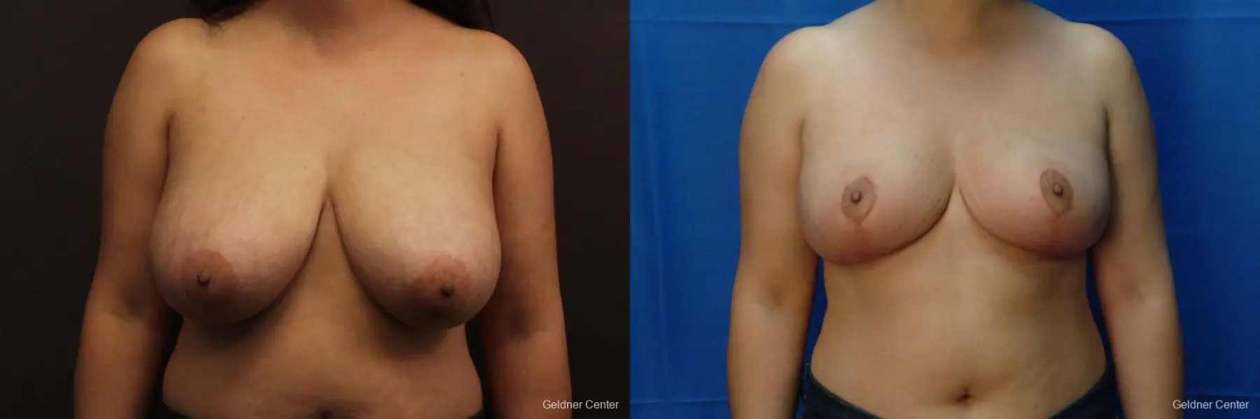 Chicago Breast Reduction 2416 - Before and After 1