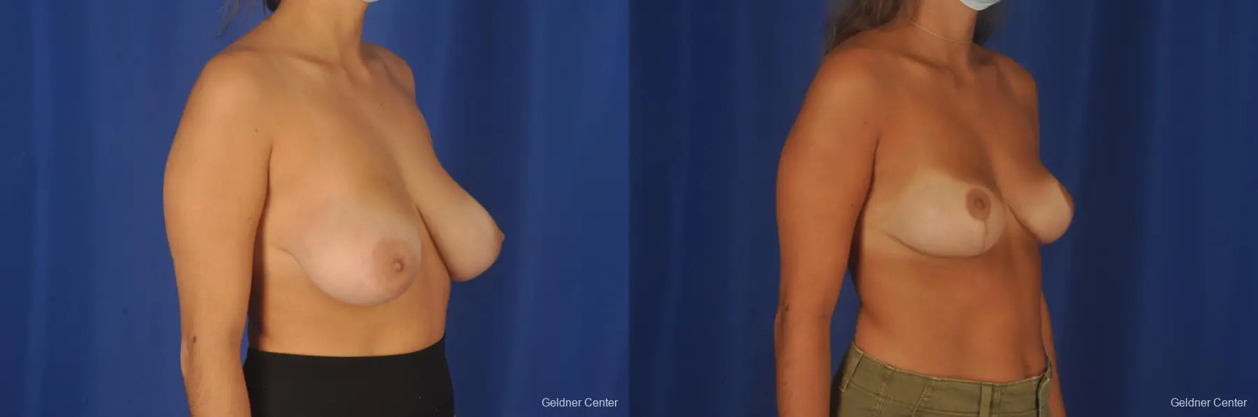 Breast Reduction: Patient 36 - Before and After 3
