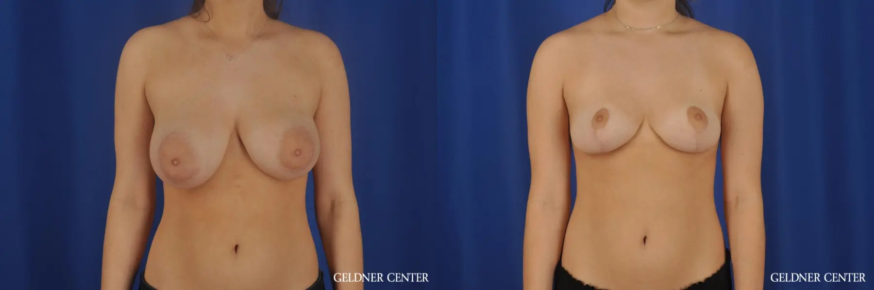 Chicago Breast Reduction 8752 - Before and After