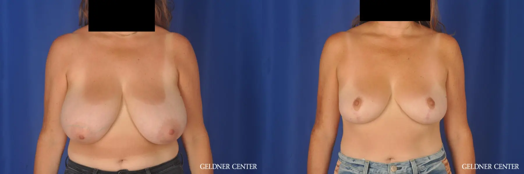 Breast Reduction: Patient 13 - Before and After 1