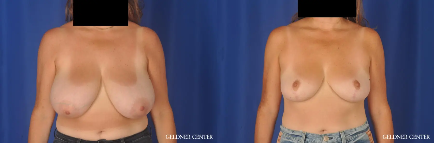 Breast Reduction: Patient 13 - Before and After  