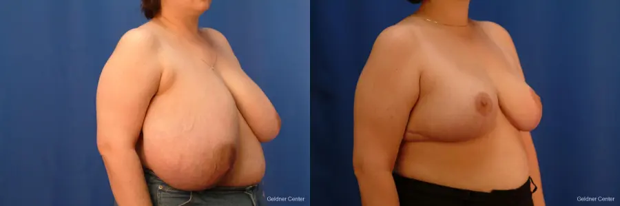 Breast Reduction Streeterville, Chicago 2522 - Before and After 3