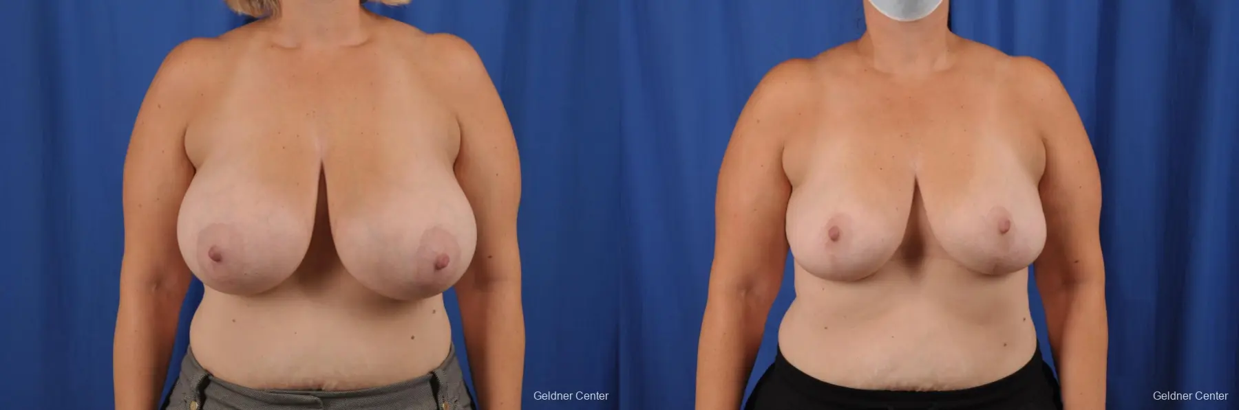 Breast Reduction: Patient 37 - Before and After  
