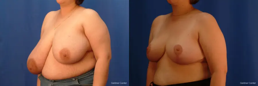 Breast Reduction Streeterville, Chicago 2522 - Before and After 4